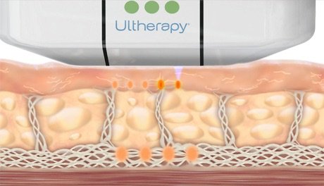 ultherapy penetrating fat layers infographic
