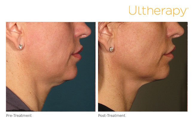 ultherapy before after chin