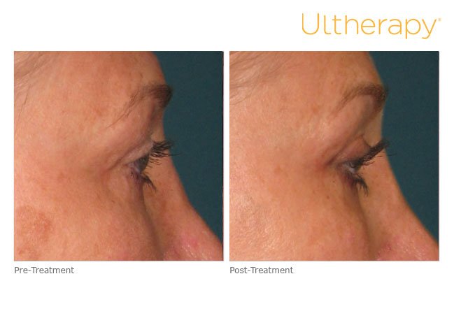 ultherapy before after face